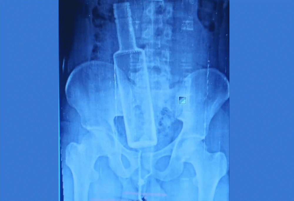 मन्सुरीको पेटमा कसले घुसाइदियो सिसाको बोतल ?